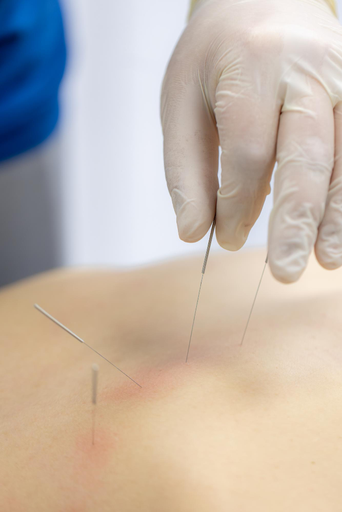 Jarum akupunktur halus yang digunakan untuk terapi di Askun Wellness